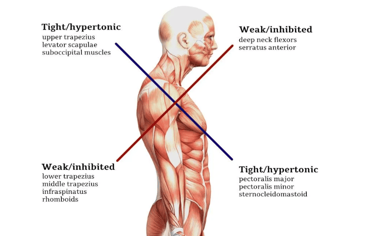 Image of upper crossed syndrome from yoganatomy.com