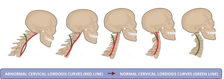 https://levelspine.com.au/what-should-your-neck-curve-look-like/